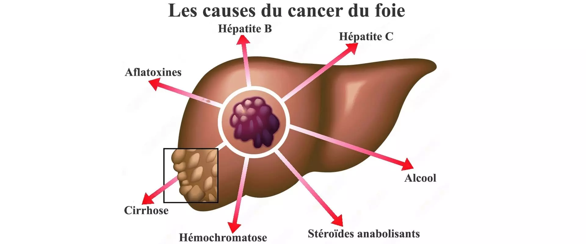 Infographie : Causes du cancer du foie